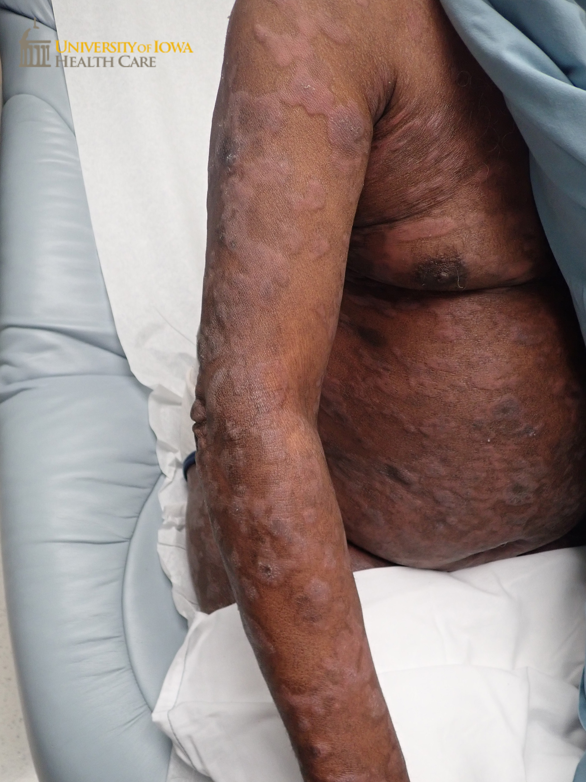 Diffuse pink to gray thick scaly plaques on the trunk and upper extremity. (click images for higher resolution).